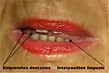Fig. 3. Vidéographie numérique chez le patient adulte : empreintes dentaires et interposition linguale lors de la phonétique.