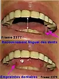 Fig.16. KA, adulte, vidéographie numérique, image 2375 et 2377. Empreintes dentaires, large espace phonétique et interposition linguale.