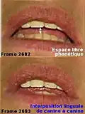 Fig.17. KA, adulte, vidéographie numérique, image 2682 et 2683. Espace phonétique réduit et interposition linguale étendue.
