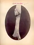 Soudure d'une fracture due à une blessure de guerre (archives médicales américaines de la Guerre civile)