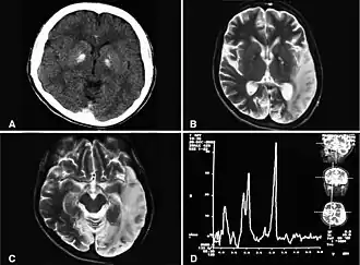 Description de l'image A computed tomography brain scan showing bilateral basal ganglia calcification.jpg.