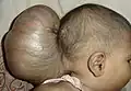 Description de l'image A neonate with a large encephalocele.jpg.