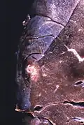 Un abcès sous-pleural.