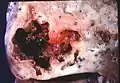 Image de pathologie d'un abcès pulmonaire.