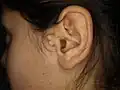 Enchondromes préauriculaires&nbsp;(en).