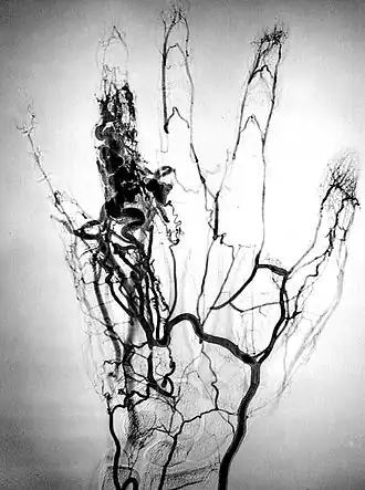 Angiome annulaire.