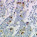 Photographie couleur de cellules de microscope avec une coloration bleue et des cellules marrons qui ont réagi à un produit par immunomarquage