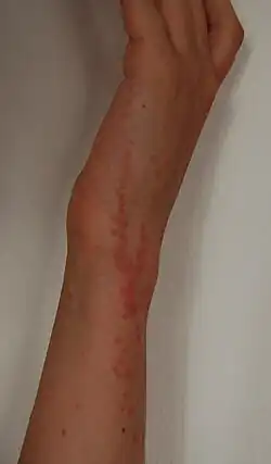 Un avant bras plein de pustules rougissantes, plus ou moins alignées.