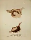 Planche anatomique de l’estomac. Deux estomacs sont représentés. Le premier est ramolli. Le deuxième est recouvert d’ulcères folliculeux.