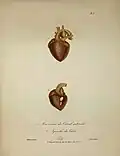 Planche anatomique représentant un anévrisme du canal artériel et un squirrhe du cœur.