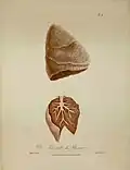 Planche anatomique représentant des tubercules sur un poumon.
