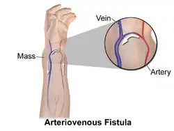Schéma d'une fistule artério-veineuse