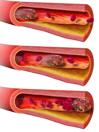 Description de l'image Blausen 0089 BloodClot Motion.png.