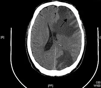 Description de l'image Brain - CT scan - Metastatic pulmonary adenocarcinoma Case 239 (7603361920).jpg.