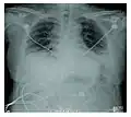 Radiographie montrant une réduction marquée de la capacité pulmonaire