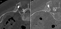 A-Pendant l'ablation, l'électrode micro-onde est directement insérée dans la métastase. B-En fin d'ablation, un mélange de ciment pour os et de sulfate de baryum est injecté dans l'espace vide créé.