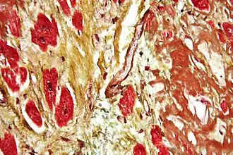 Description de l'image Cardiac amyloidosis very high mag movat.jpg.