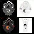 Métastases ostéolytiques dans la deuxième vertèbre du cou  (Axis) d'un cancer de la prostate.