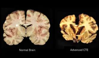 Description de l'image Chronic Traumatic Encephalopathy.png.