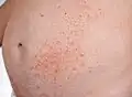 Dermatite herpétiforme - Ventre