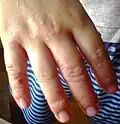 Dermatite herpétiforme – Vésicules et gonflement dans les doigts, aussi commun dans les pieds