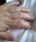Dermatite herpétiforme – Vésicules et gonflement dans les mains