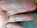 Dermatite herpétiforme – Vésicules et gonflement dans les mains