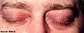 Heliotrope, souvent associé à un œdème périorbitaire et des télangiectasies des paupières supérieures. En phase de guérison, l'atrophie ou dépigmentation (hypo-ou hyperpigmentation) peut être visible. ici : œdème léger des deux paupières supérieures, avec extension aux paupières inférieures.