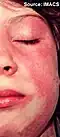 érythème Malar et du visage. Apparu brusquement, dont en péri-orbitaire et malaire avec l'extension vers le menton (jeune fille).