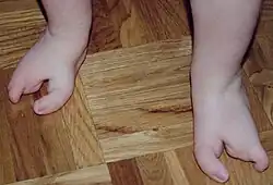 Ectrodactylie des deux pieds à un an