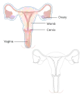 A radical hysterectomy to treat vaginal cancer without reconstruction