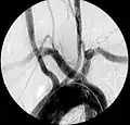 Artère sous-clavière droite aberrante à l'angiographie.