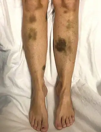 Description de l'image Echymosis.jpg.