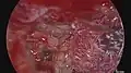 Visualisation endoscopique d'une platinotomie