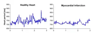La variabilité de la fréquence cardiaque est affectée après l'infarctus.