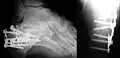 Radio d'une fracture comminutive du calcanéum
