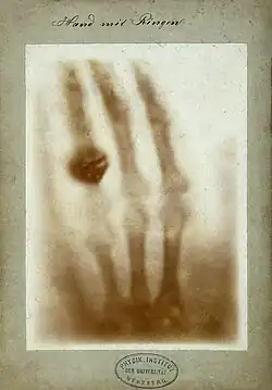 Photographie de la première radiographie de l'histoire prise le 22 décembre 1895 sur la main d'Anna Bertha Röntgen, la femme du découvreur des rayons X.