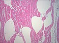 Biopsie de muscle examinée au microscope (colorée à l'haematoxyline-éosine, zoom 100×). Les vides blancs entre les fibres musculaires correspondent à des bulles de gaz.