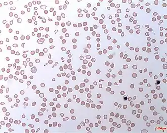 Description de l'image Haemolytic Anaemia.jpg.