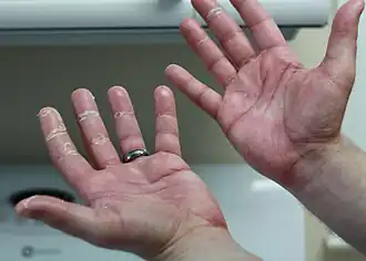 Description de l'image Hand-foot Syndrome.jpg.