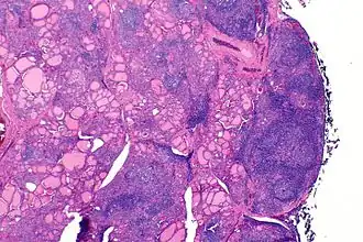 Description de l'image Hashimoto thyroiditis - alt -- very low mag.jpg.