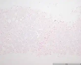Description de l'image Hemochromatosis liver section.JPG.
