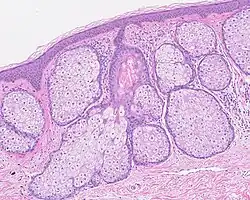 Multiples glandes sébacées volumineuses réalisant une hyperplasie sébacée.