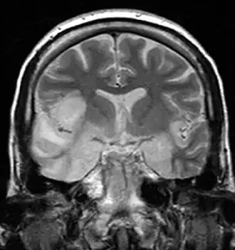 Description de l'image Hsv encephalitis.jpg.