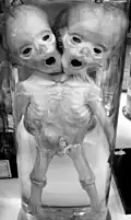Bébés humains siamois.