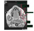 IRM de tête au niveau des dents mandibulaires, avec le muscle masséter.