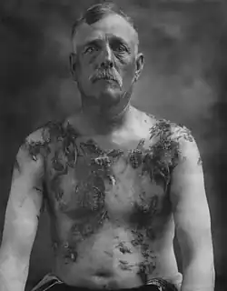 Photographie en noir et blanc représentant un homme à mi-corps, torse nu, vu de face, avec des touffes de poils adhérant au corps.