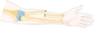 Description de l'image Kind of fractures - Open fracture -- Smart-Servier.png.