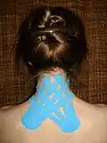 Bandage à la face postérieure de la nuque et de la ceinture scapulaire.