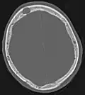 Par comparaison, scanner de métastases ostéolytiques dans l'os du crâne d'une patiente souffrant d'un cancer du sein. On distingue une ostéolyse plus grande sur le front, et plusieurs plus petites.